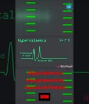 Hipercalemia Short